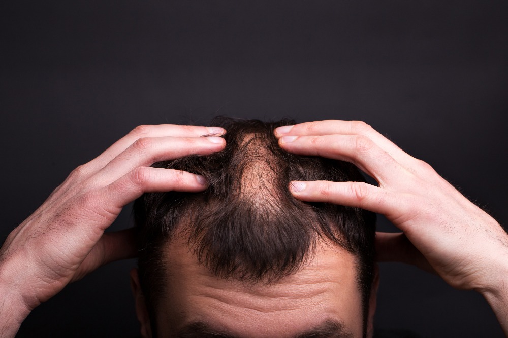 What to Expect Before, During, and After Your Hair Transplant